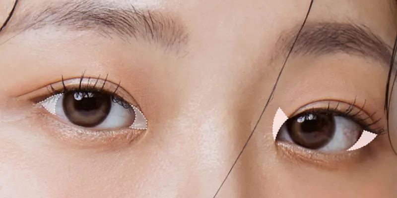 Phẫu Thuật Mở Góc Mắt Là Gì?