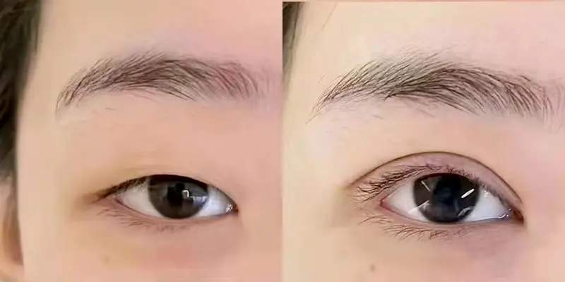 Ai nên thực hiện phẫu thuật mở góc mắt?