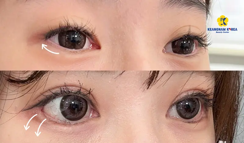 Khách hàng cắt mí mở góc mắt 1