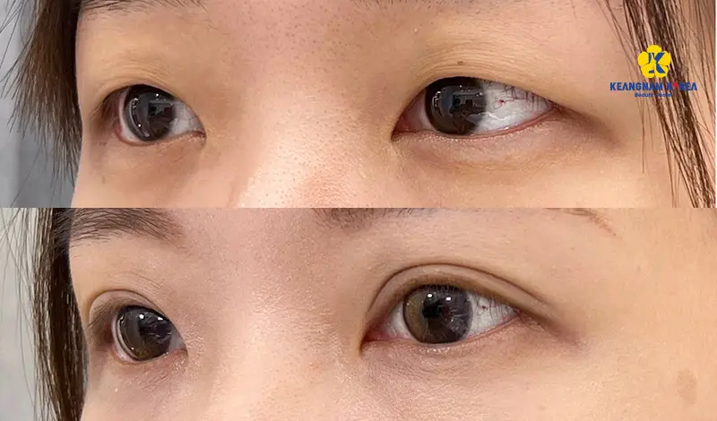 Khách hàng cắt mí mở góc mắt 3