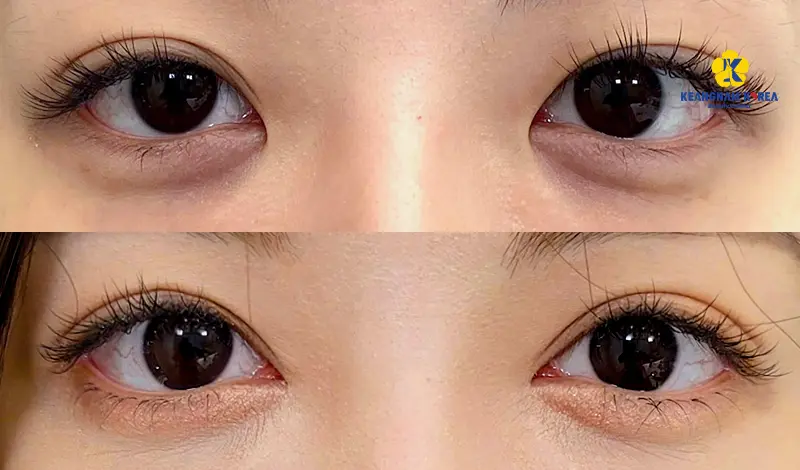 Khách hàng cắt mí mở góc mắt 2