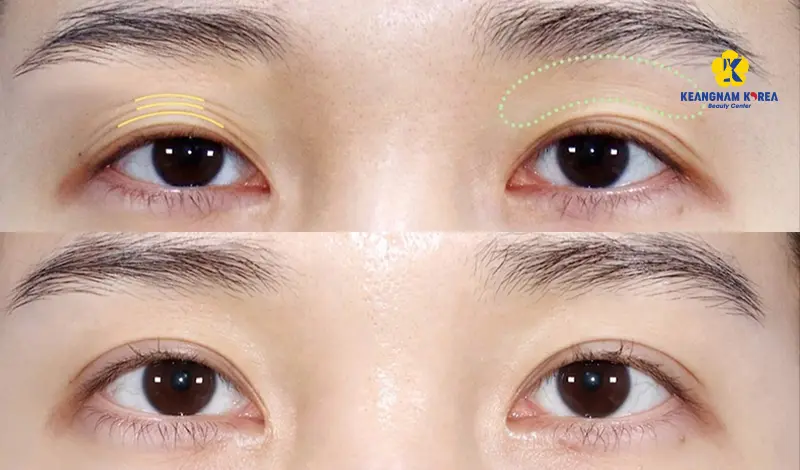 Khách hàng cấy mỡ hốc mắt 1