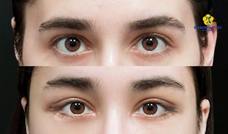 Khách hàng cấy mỡ hốc mắt 2