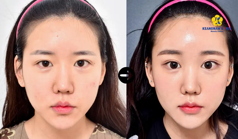 Khách hàng nâng cơ mí mắt