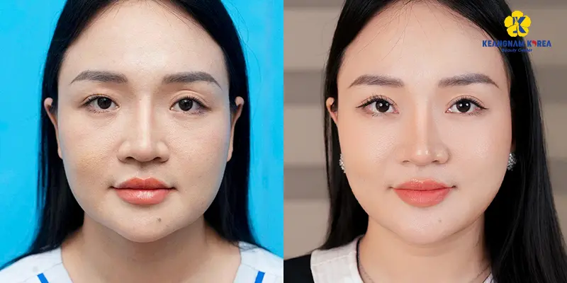 Khách hàng nâng cung mày 1