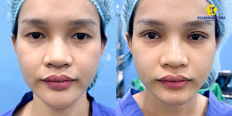 Khách hàng nâng cung mày 2