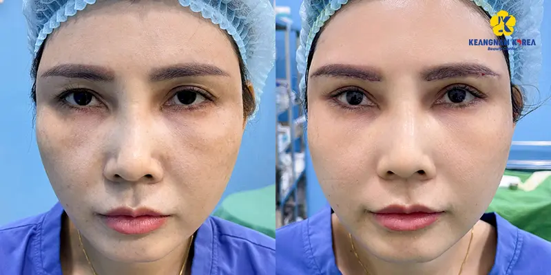 Khách hàng nâng cung mày 3