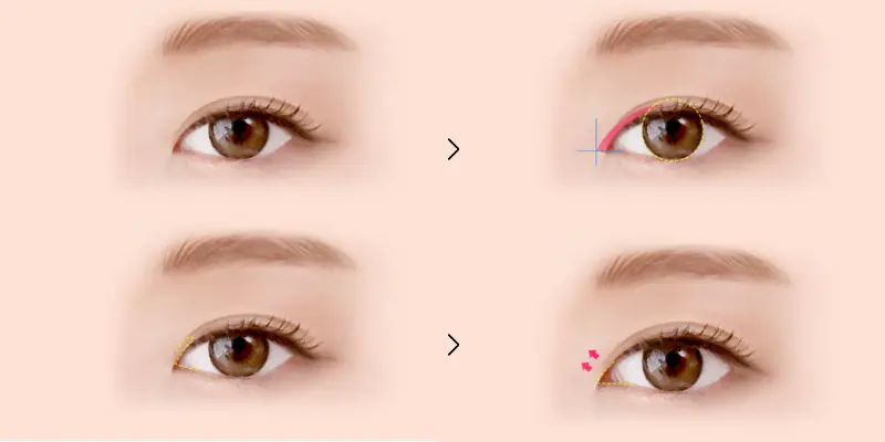 Mở Góc Mắt Ngoài