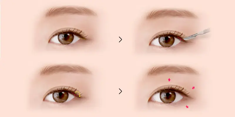 Mở Góc Mắt Trong