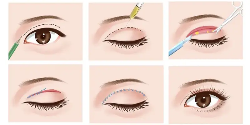 Quy trình cấy mỡ hốc mắt chuẩn y khoa