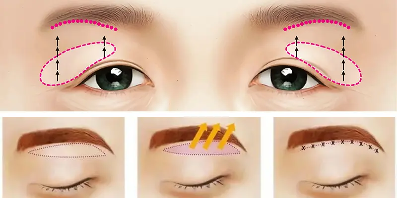 Nâng Cung Chân Mày Là Gì?