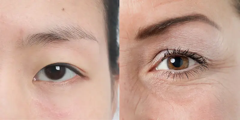 Khi Nào Nên Nâng Cơ Mí Mắt?