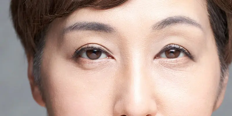 Sụp mí là gì? Sụp mí 1 bên