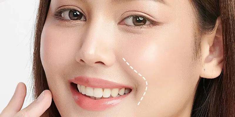 Xóa Rãnh Cười Vĩnh Viễn Được Không?