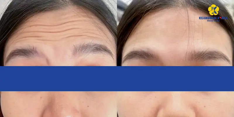 Khách hàng thực hiện xóa nhăn căng da trán 3