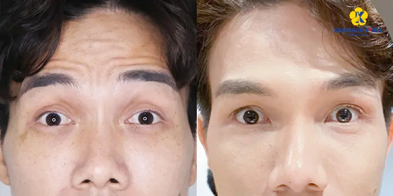 Khách hàng thực hiện xóa nhăn căng da trán 1