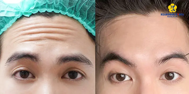 Khách hàng thực hiện xóa nhăn căng da trán 2