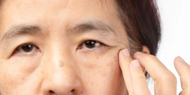 Sụp mí mắt là gì?