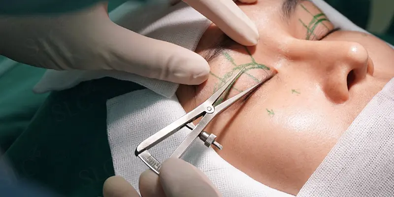 Phẫu thuật chỉnh sụp mí 