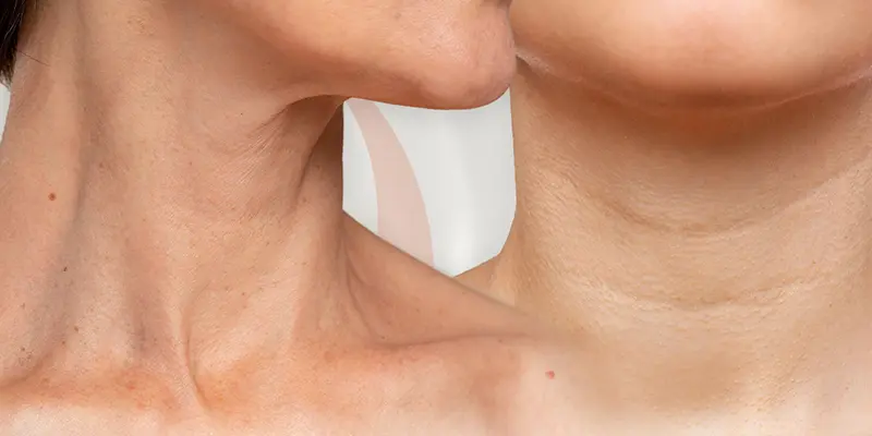 Căng Da Cổ Không Phẫu Thuật