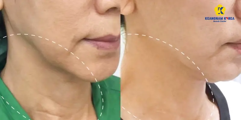 Căng da cổ không phẫu thuật là gì?