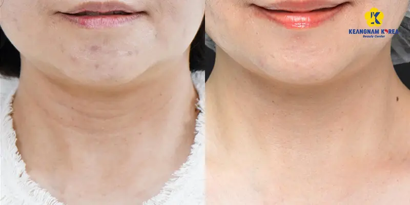 Khách hàng thực hiện căng da cổ không phẫu thuật