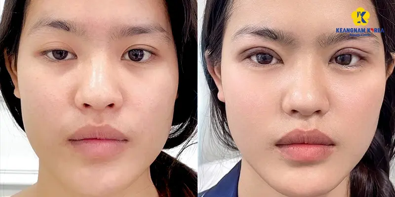 Phẫu thuật chữa sụp mí mắt bẩm sinh