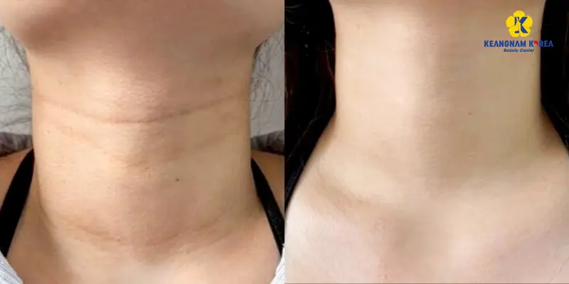 Khách hàng thực hiện căng da vùng cổ