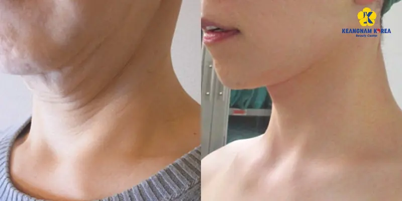 Khách hàng thực hiện căng da vùng cổ