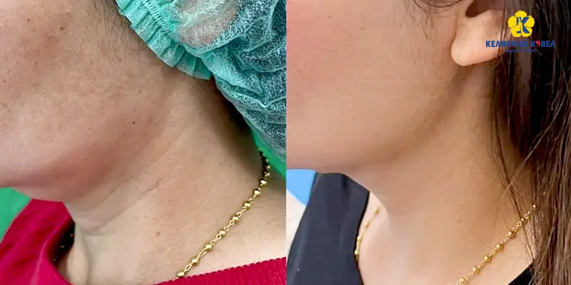 Khách hàng thực hiện căng da vùng cổ