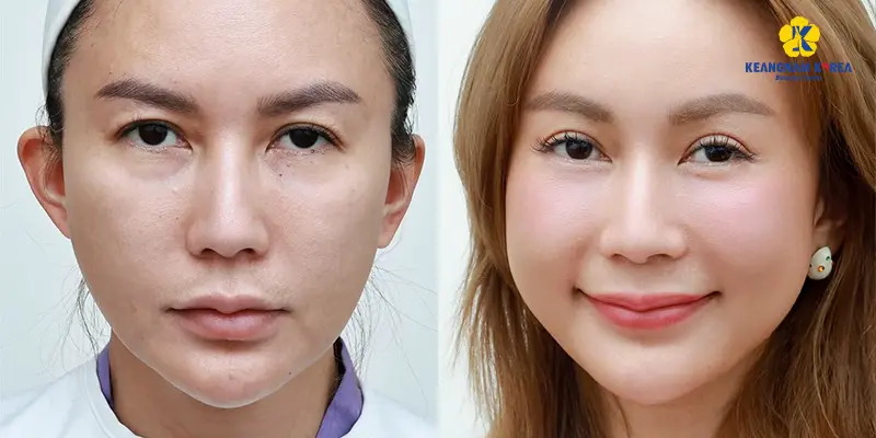 Khách hàng thực hiện treo cung mày 3