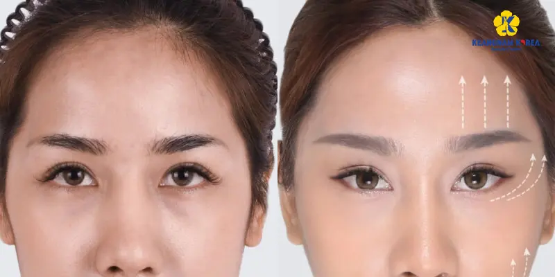 Khách hàng thực hiện treo cung mày 2