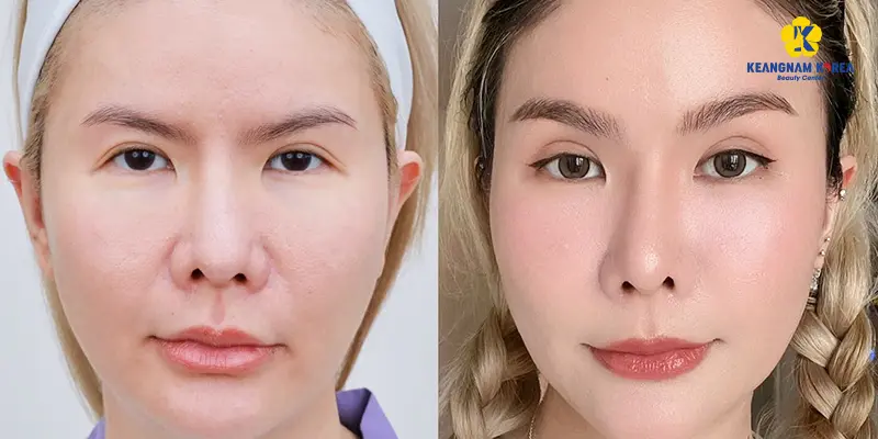 Khách hàng thực hiện treo cung mày 1