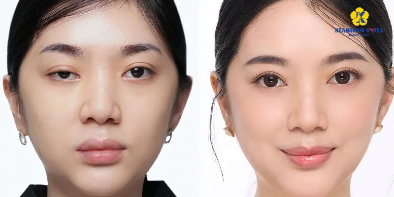 Khách hàng thẩm mỹ mắt sụp mí 2