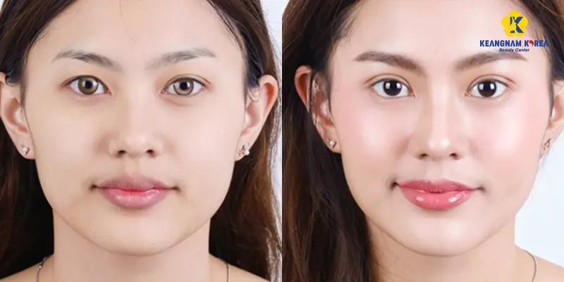 Khách hàng thẩm mỹ mắt sụp mí 