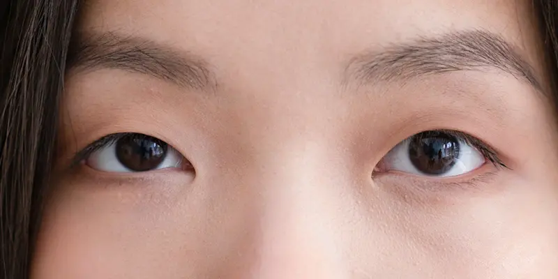 Tự nhiên bị sụp mí mắt là gì? 