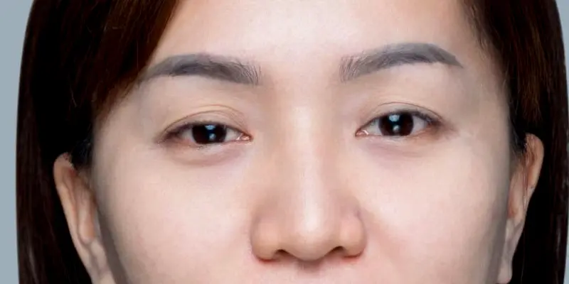 Sụp mí mắt bẩm sinh