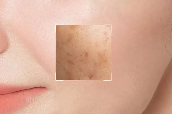 4 loại nám da phổ biến và cách trị nám lâu năm