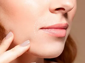 Xoá nếp nhăn quanh miệng ở đâu tốt?