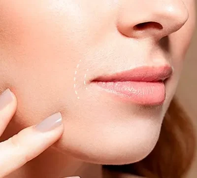 Xoá nếp nhăn quanh miệng ở đâu tốt?