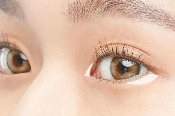 Cắt Mí Mở Góc Mắt Ở Đâu Đẹp?