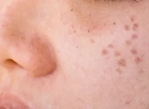Cách Trị Nám Tàn Nhang Lâu Năm