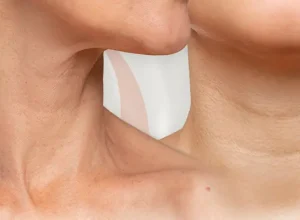 Căng Da Cổ Không Phẫu Thuật