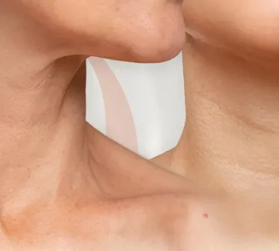 Căng Da Cổ Không Phẫu Thuật