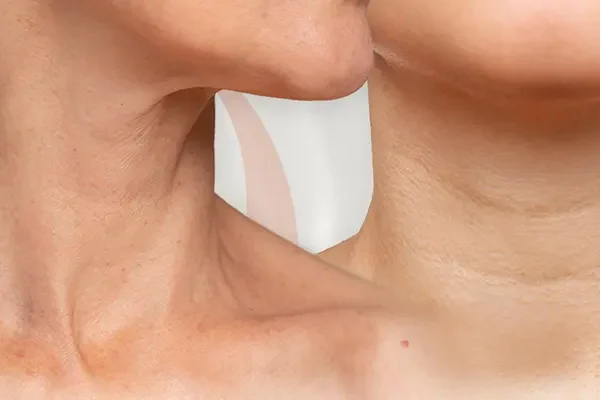 Căng Da Cổ Không Phẫu Thuật