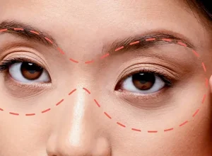 Cấy Mỡ Hốc Mắt Là Gì?