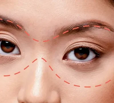 Cấy Mỡ Hốc Mắt Là Gì?