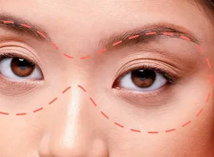 Cấy mỡ làm đầy hốc mắt