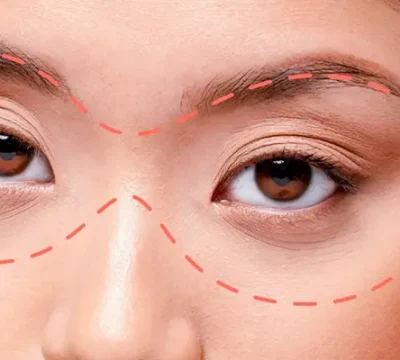 Cấy mỡ làm đầy hốc mắt