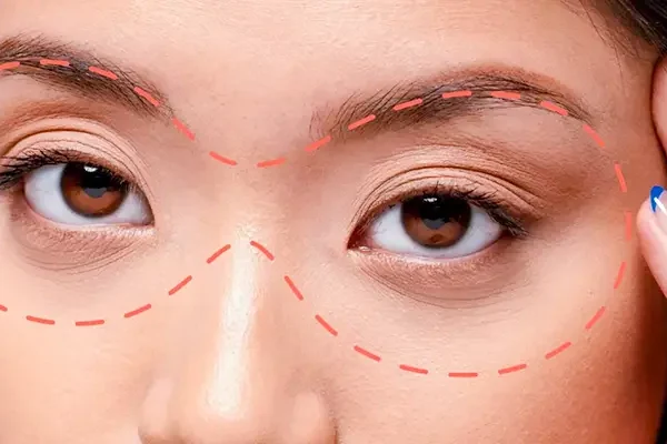 Cấy mỡ làm đầy hốc mắt